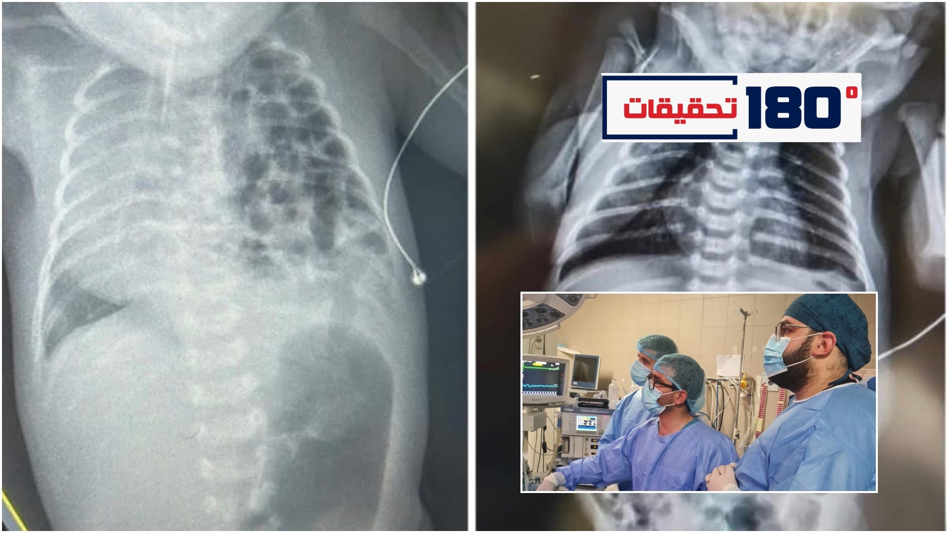 من قلب مستشفى الخليل الحكومي… إنجاز طبي يثبت أن الإبداع لا تحدّه الظروف